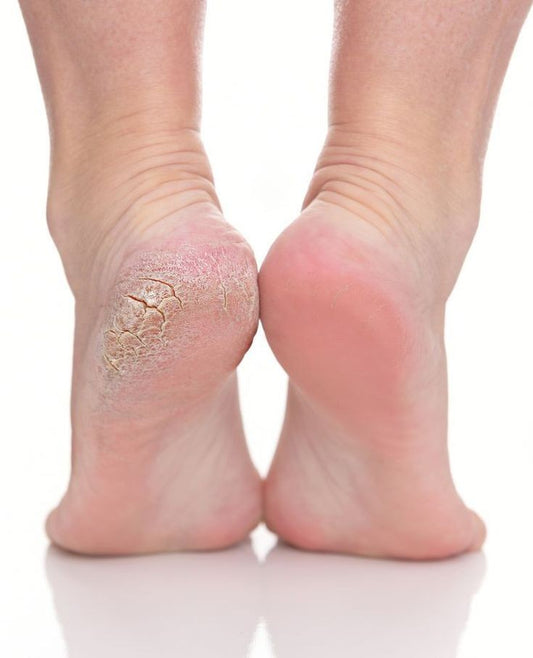 Intense Healing Foot cream for Cracked Foot (30gm)An Ayurvedic Formulation